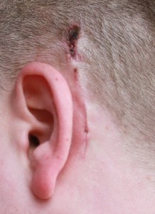 Dette billede viser hvordan mit sår ved venstre øre så ud 4 dage efter plastret blev fjernet
